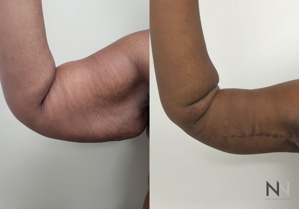 Arm Lift - Thumbnail 3