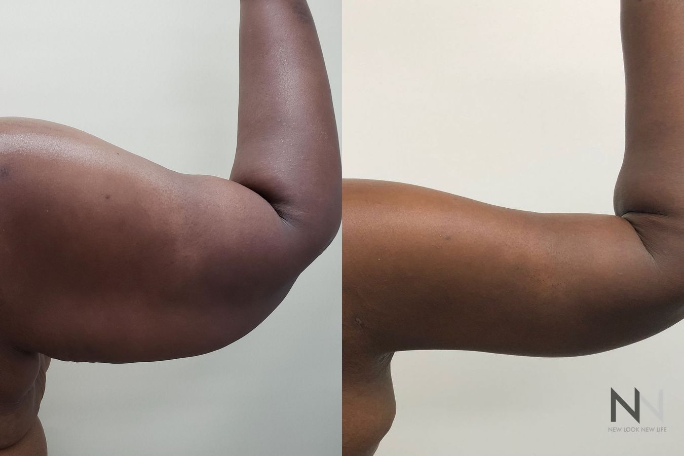 Brachioplasty results for 45-year-old female patient/ - Angle 2