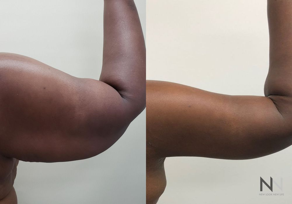 Arm Lift - Thumbnail 2