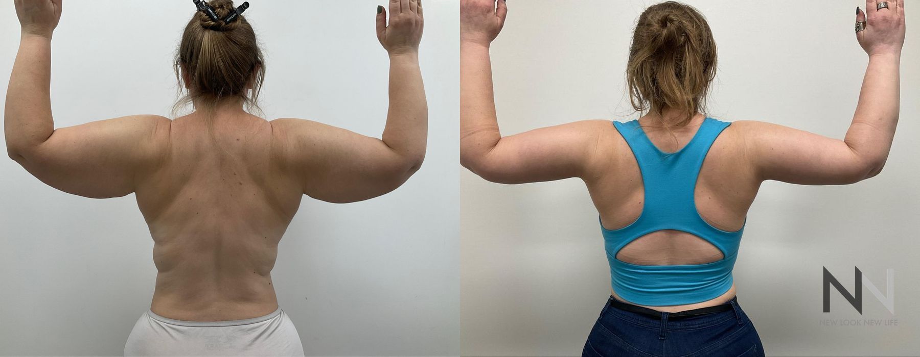 Arm Lift - Case 1963