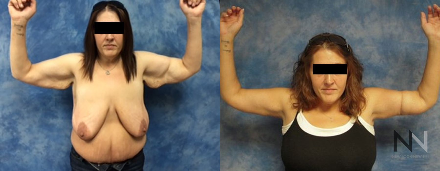 Arm Lift - Case 1971