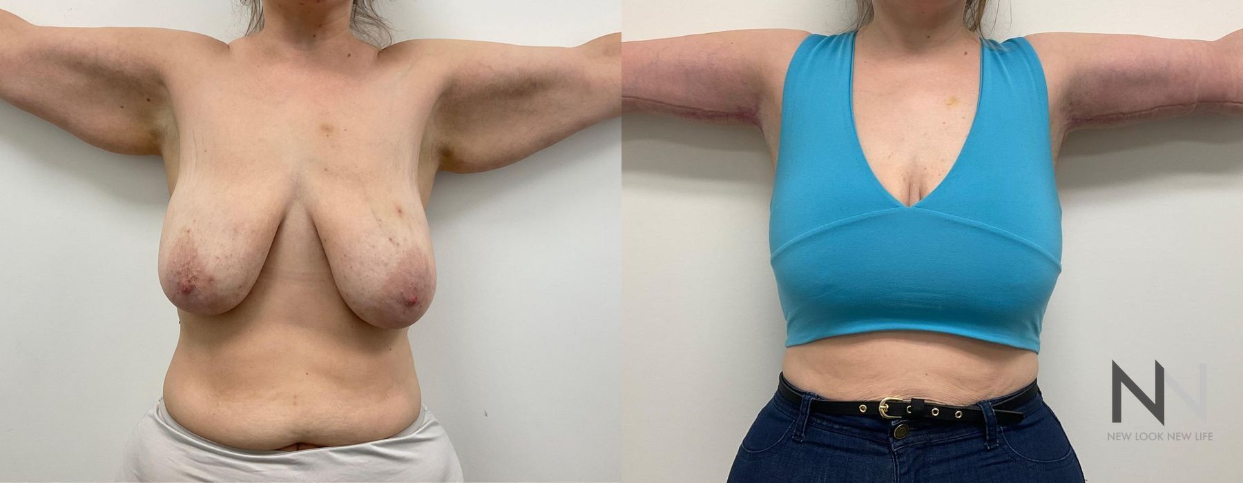 Arm Lift - Thumbnail 2