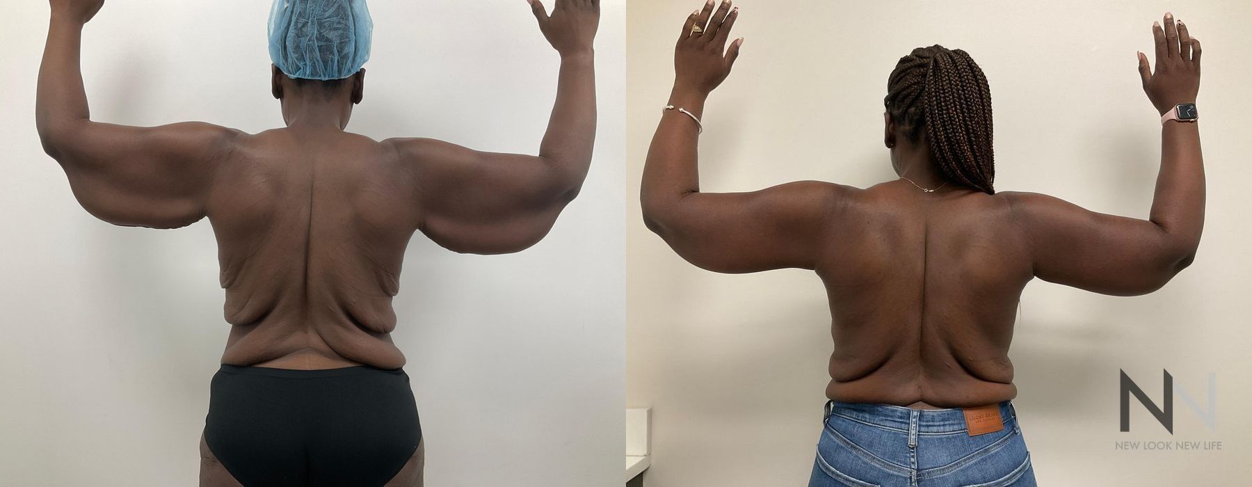 Arm Lift - Case 1778