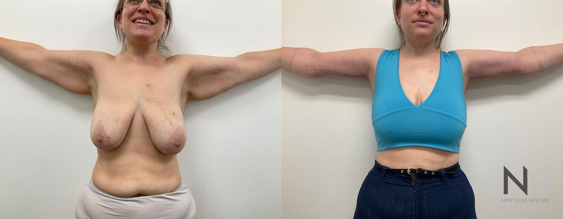 Arm Lift - Thumbnail 2