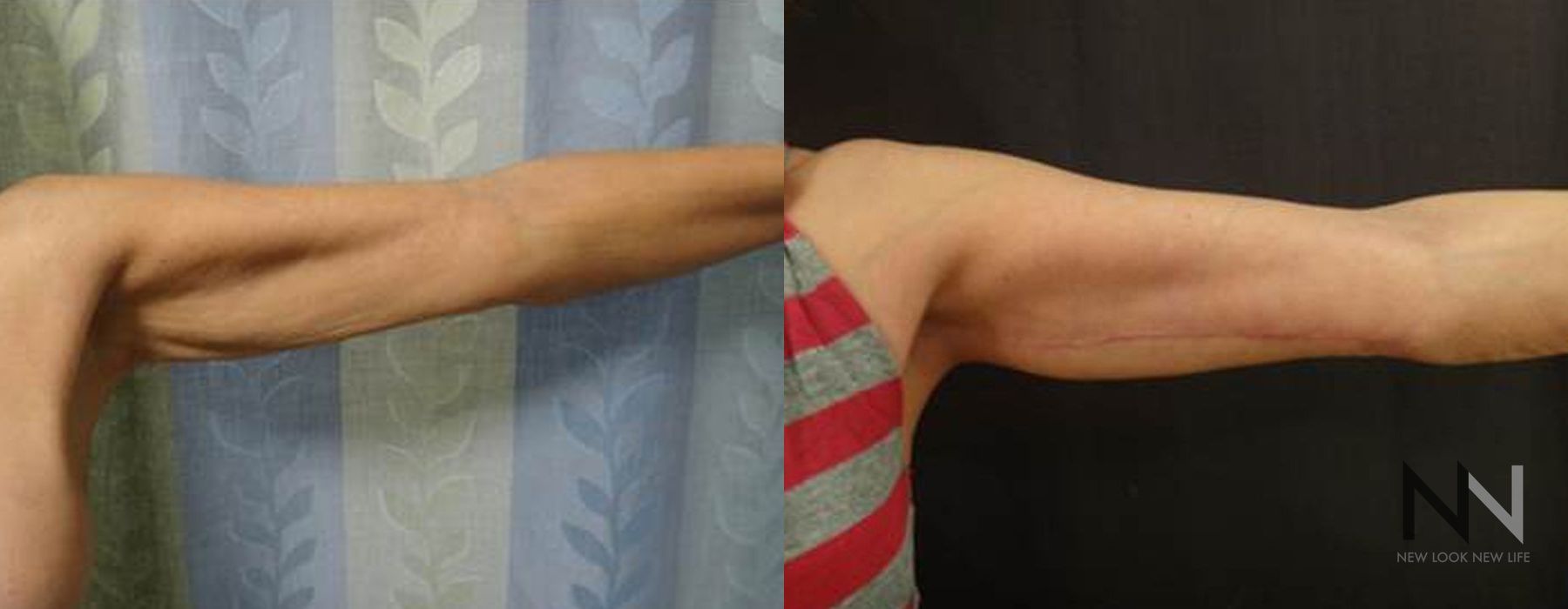 Arm Lift - Case 1785