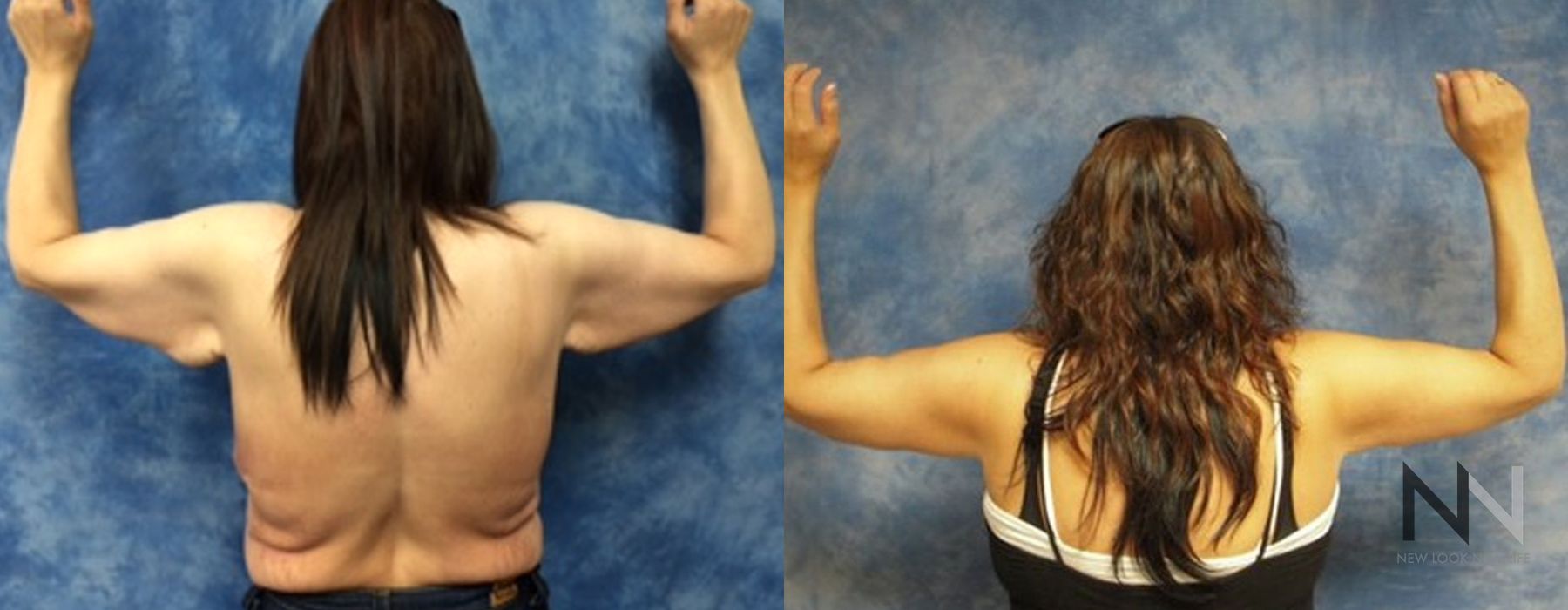 Arm Lift - Thumbnail 2