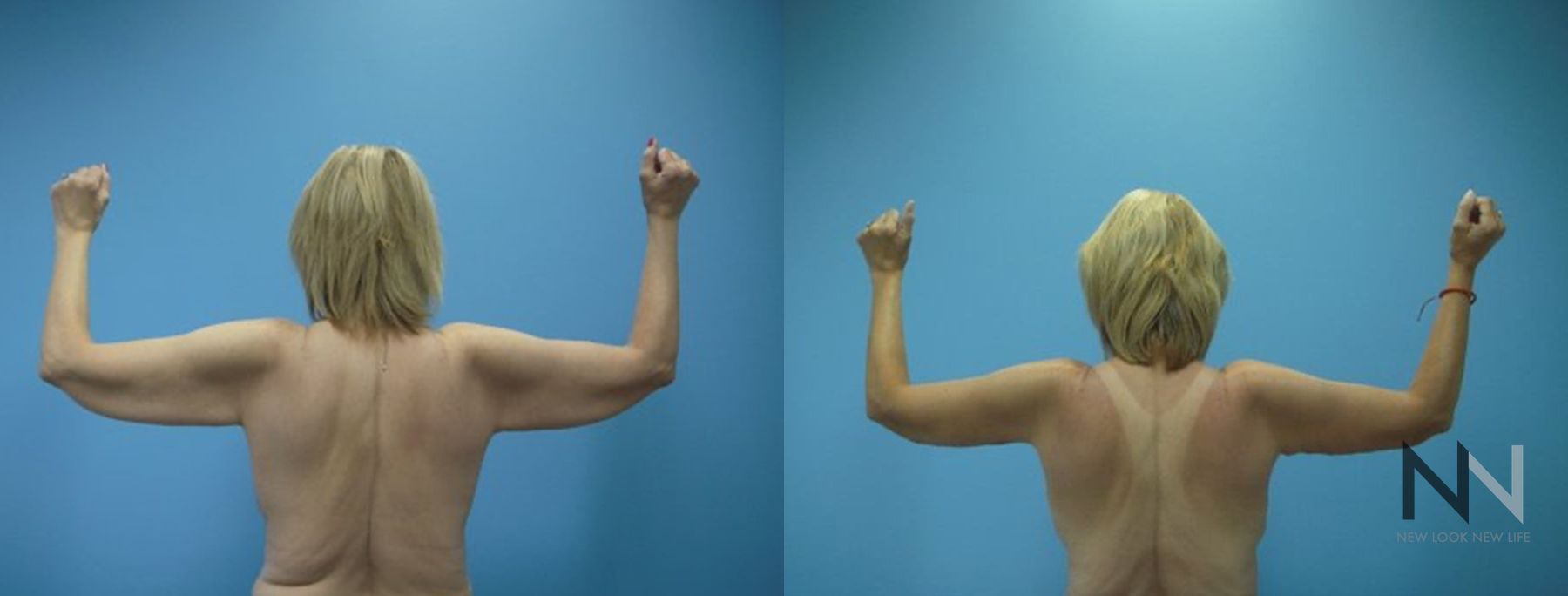 Before and after arm lift and breast lift six months results - Angle 2