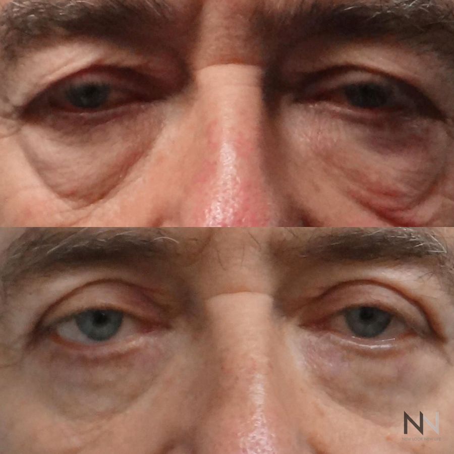 Blepharoplasty - Case 2129