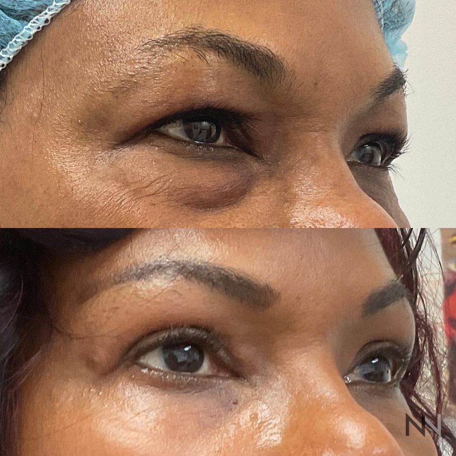 Blepharoplasty - Thumbnail 3