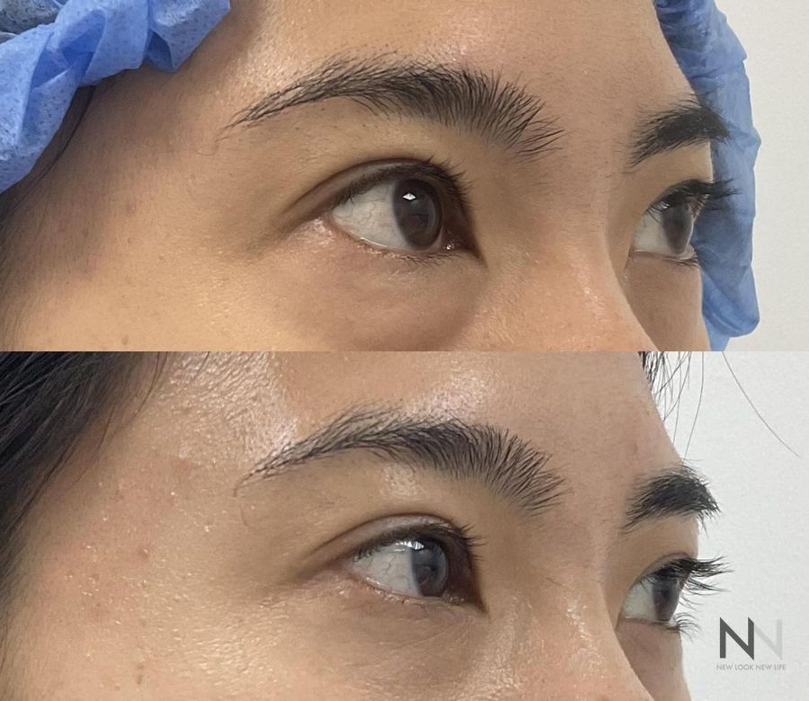 Upper blepharoplasty before and after eyelid contour improvement - Angle 3