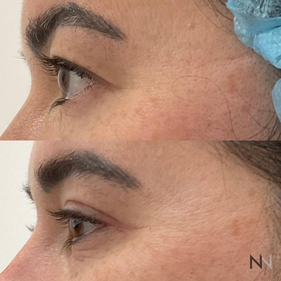 Blepharoplasty - Case 1949