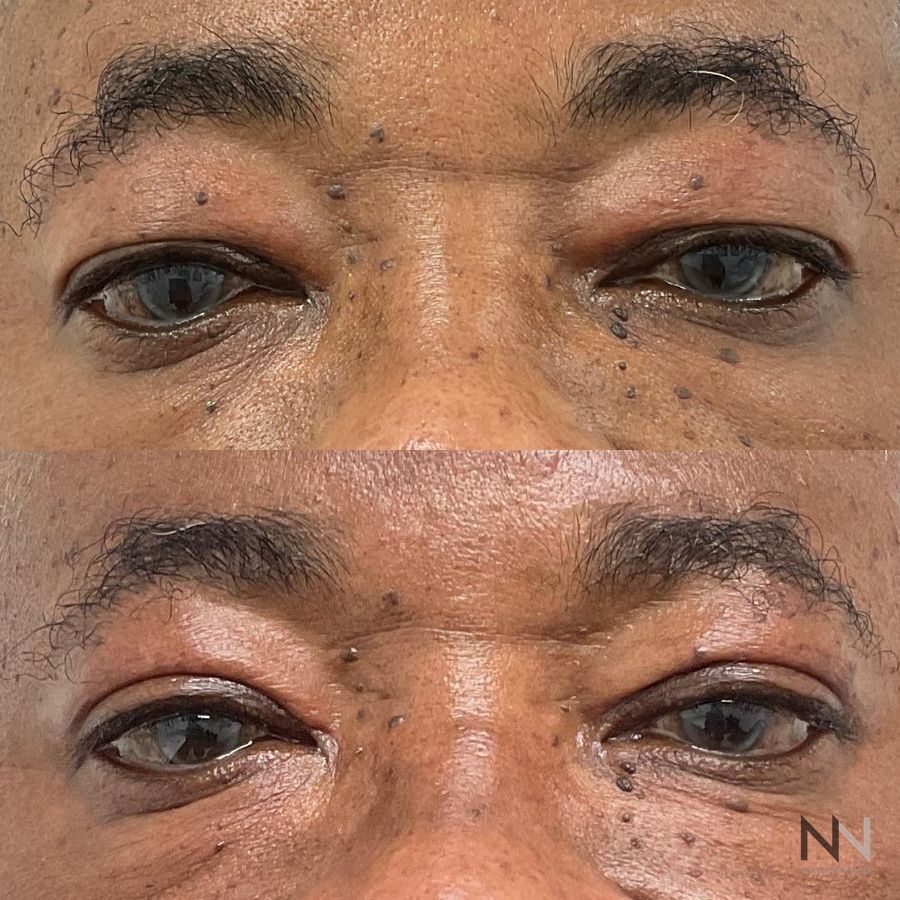 Blepharoplasty - Case 2132