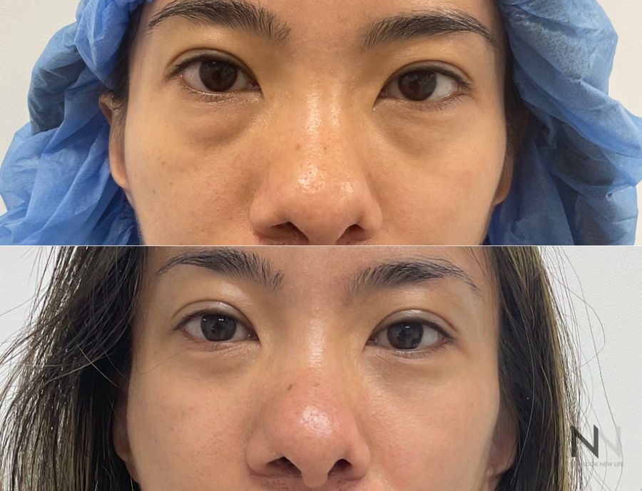 Lower blepharoplasty before and after showing refined lower eyelid contours and improved under-eye appearance by Dr. Claudia Kim in NYC.