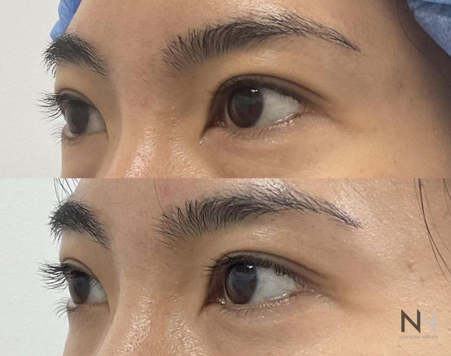 Upper blepharoplasty before and after eyelid contour improvement - Angle 2