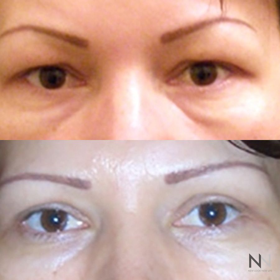 Blepharoplasty - Case 2125