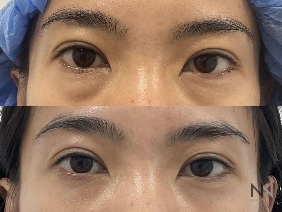 Upper blepharoplasty before and after eyelid contour improvement