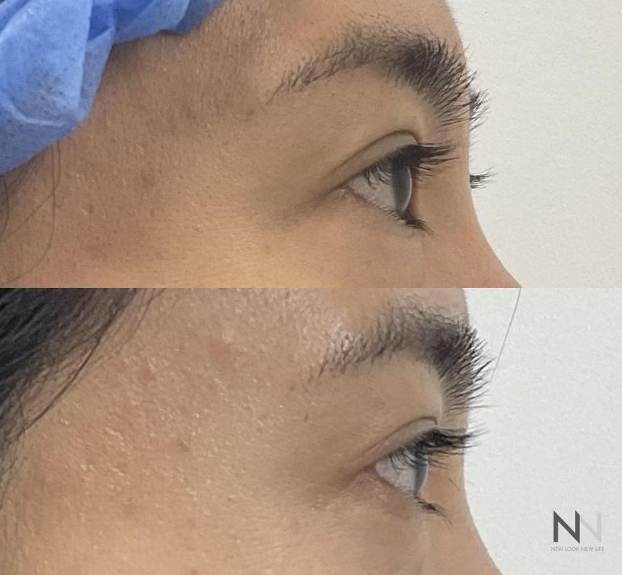 Upper blepharoplasty before and after eyelid contour improvement - Angle 4