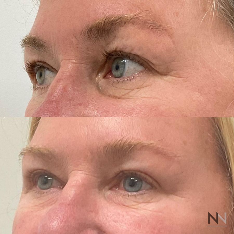 Blepharoplasty - Thumbnail 3