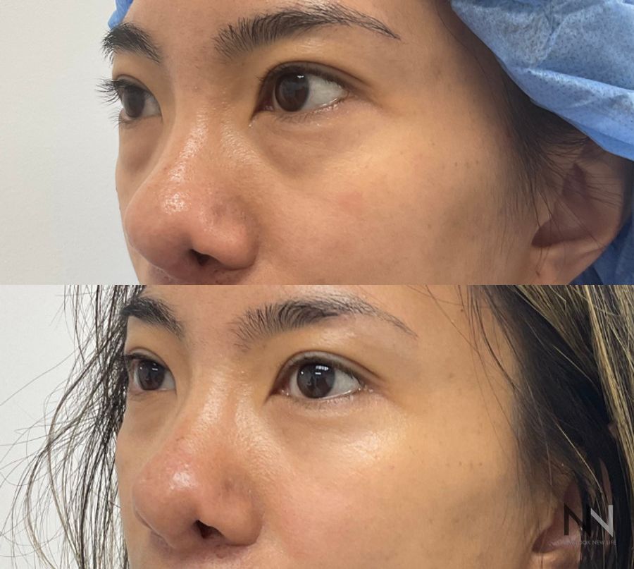 Lower blepharoplasty before and after showing refined lower eyelid contours and improved under-eye appearance by Dr. Claudia Kim in NYC. - Angle 2