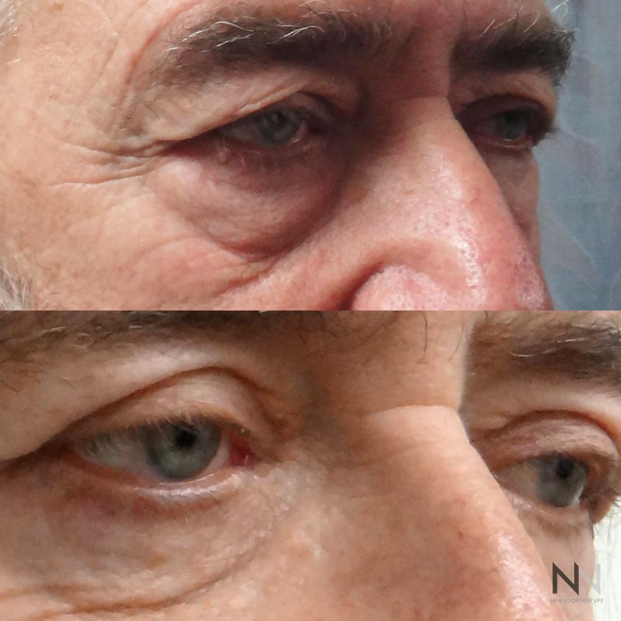 Blepharoplasty - Thumbnail 3