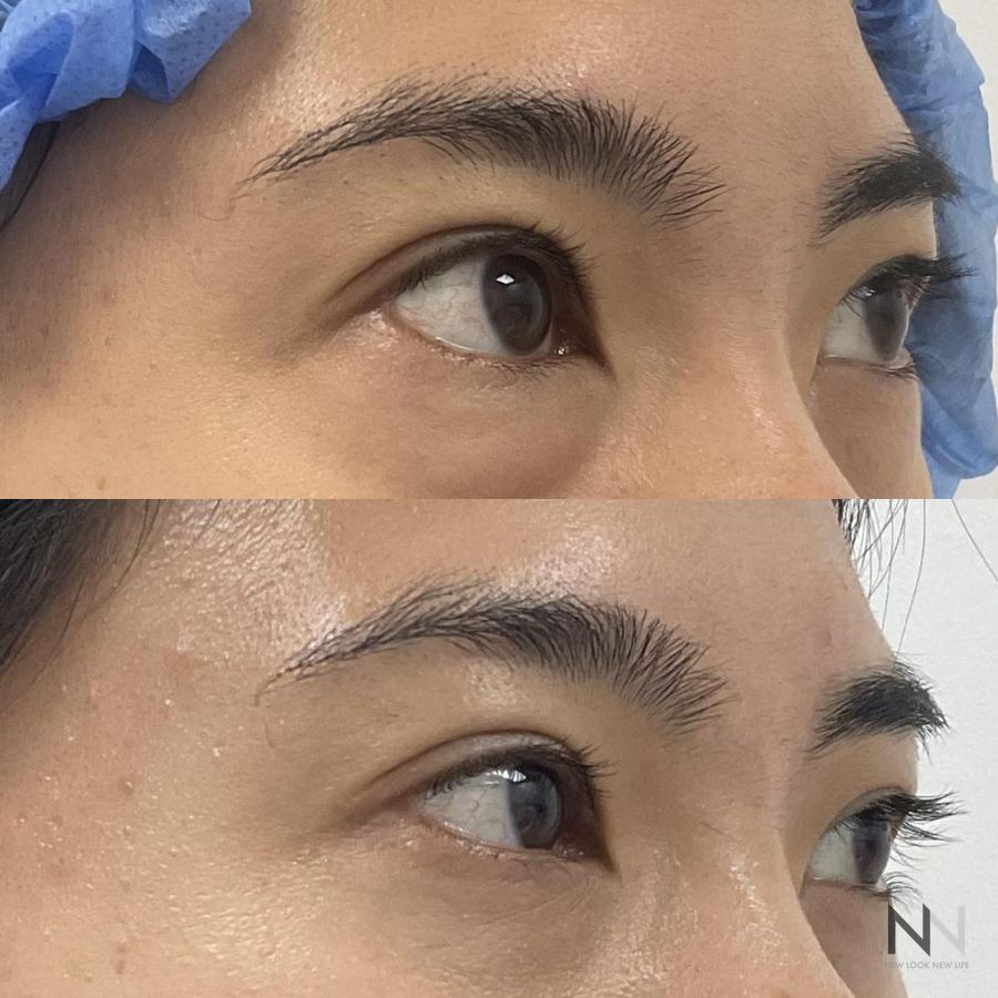 Blepharoplasty - Thumbnail 4