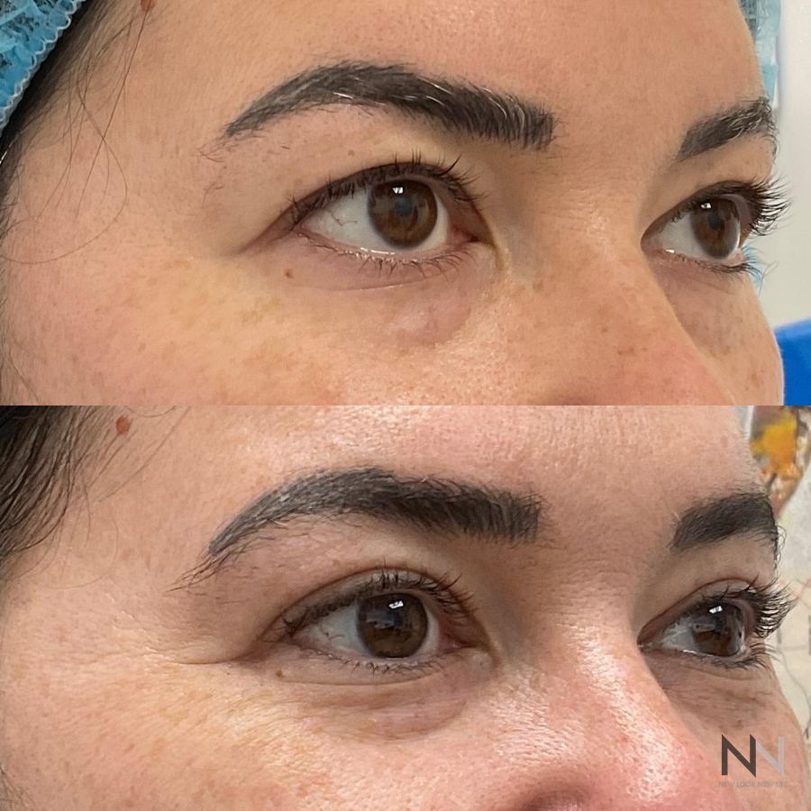 Blepharoplasty - Thumbnail 2