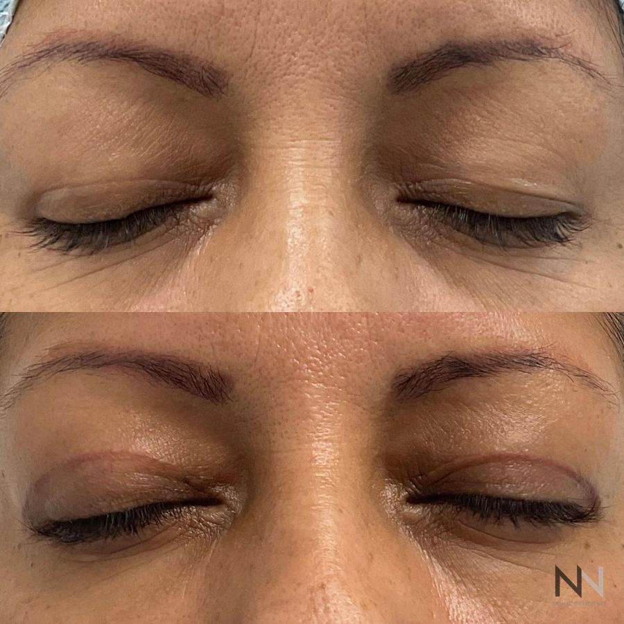 Blepharoplasty - Case 1939