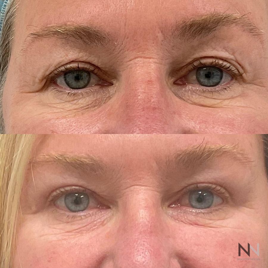 Blepharoplasty - Case 1948