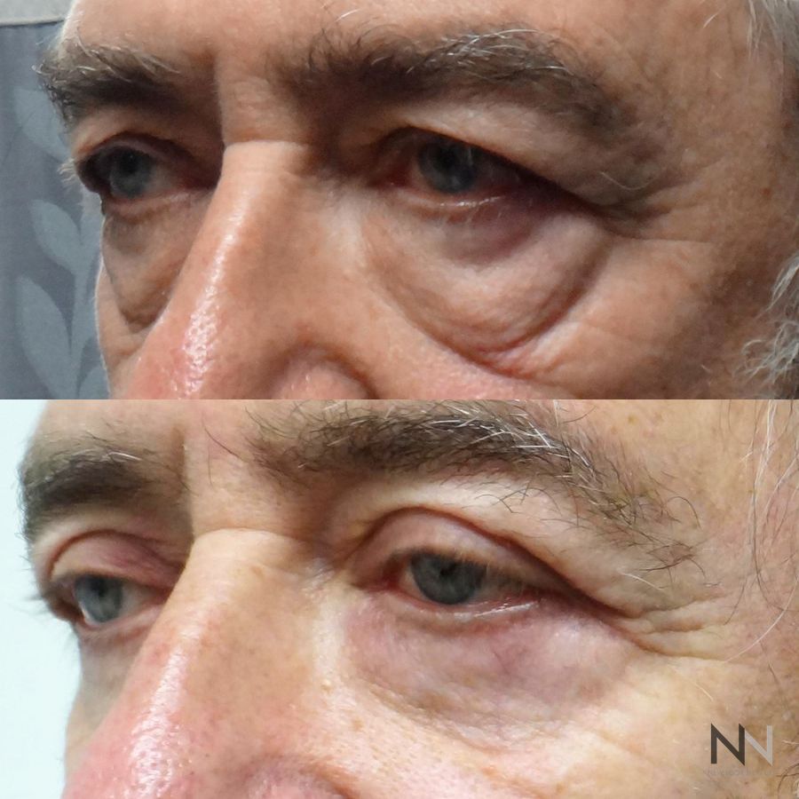 Blepharoplasty - Thumbnail 2