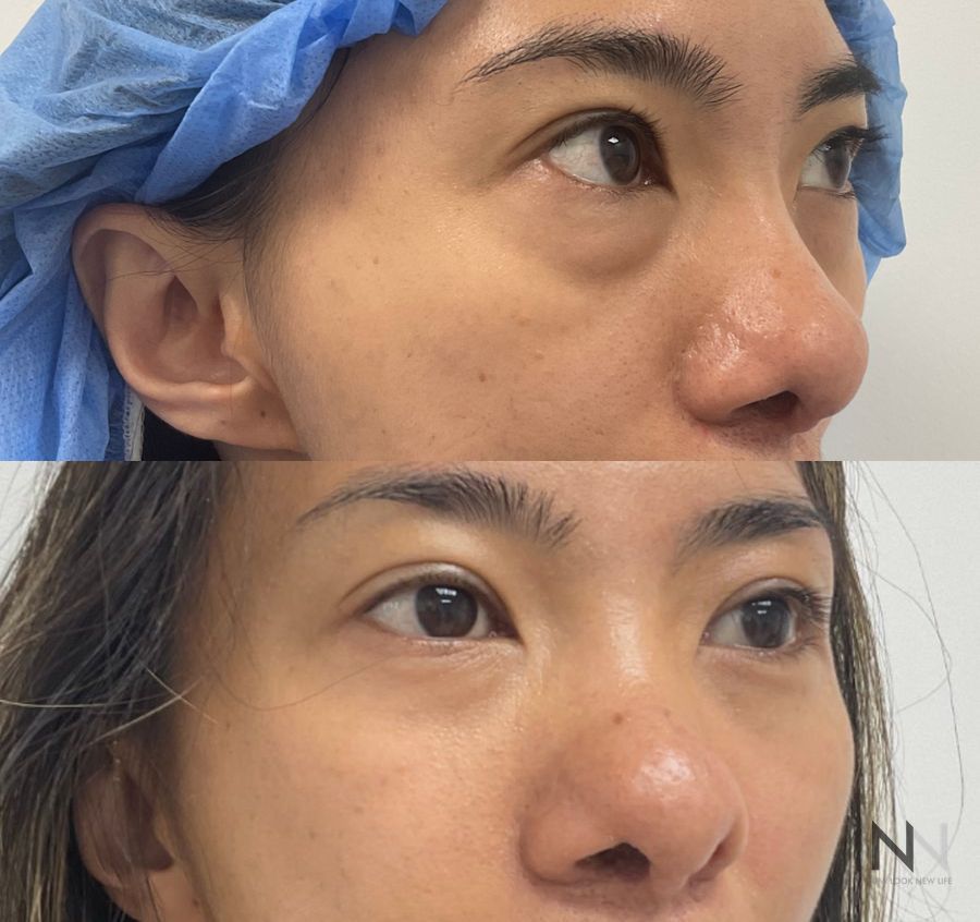 Lower blepharoplasty before and after showing refined lower eyelid contours and improved under-eye appearance by Dr. Claudia Kim in NYC. - Angle 4