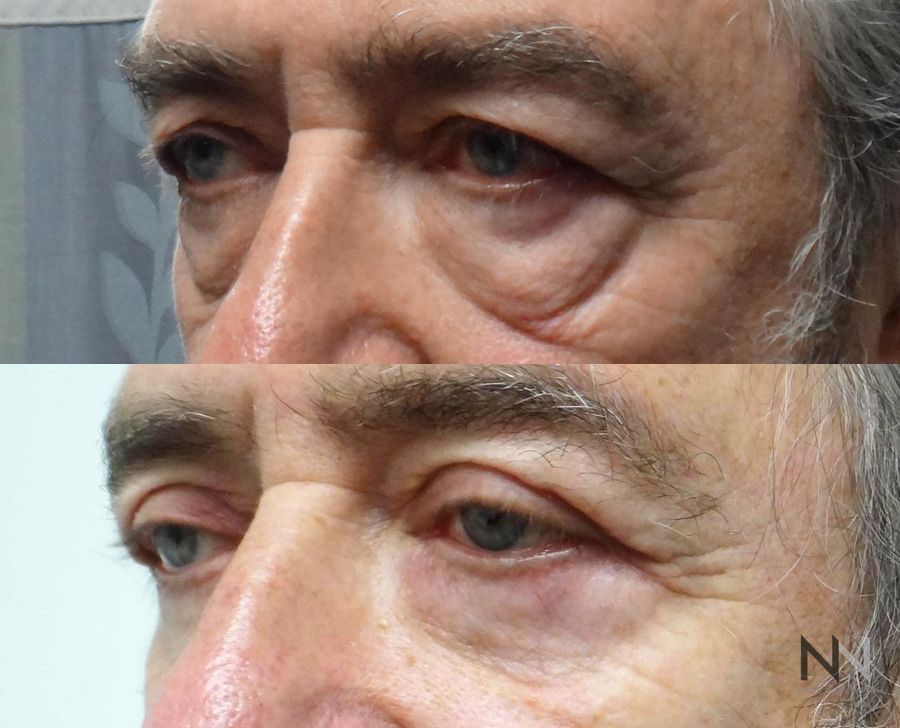 Before and after upper and lower blepharoplasty three months results