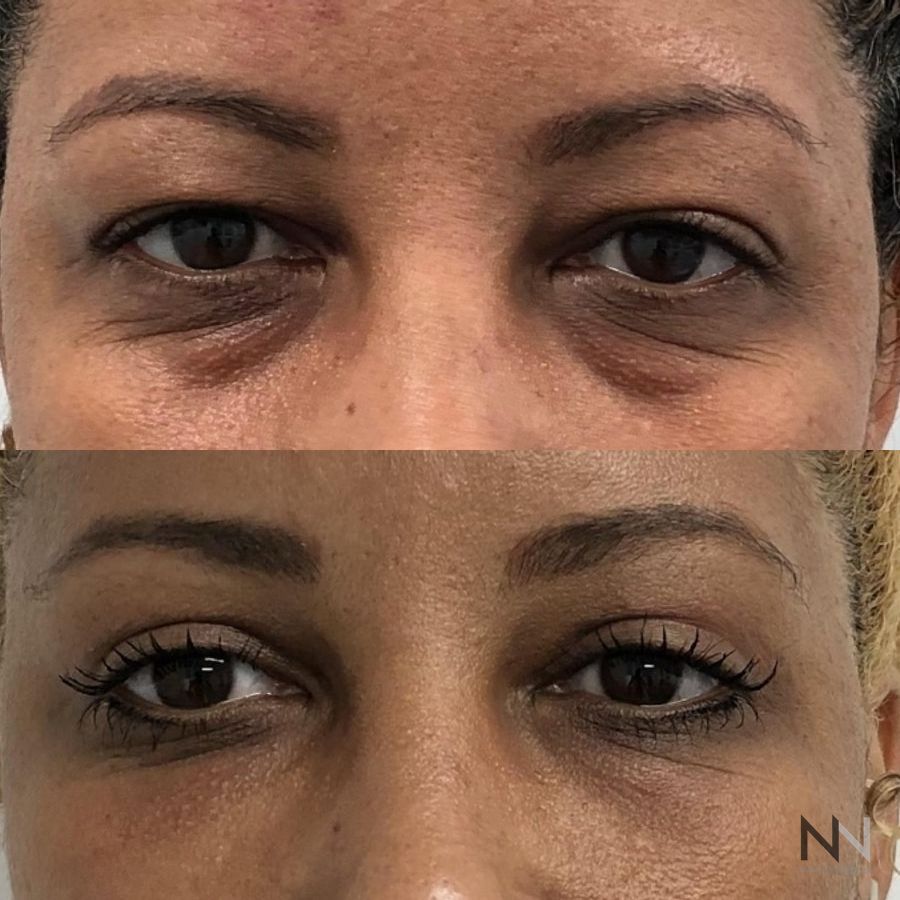 Blepharoplasty - Case 1938