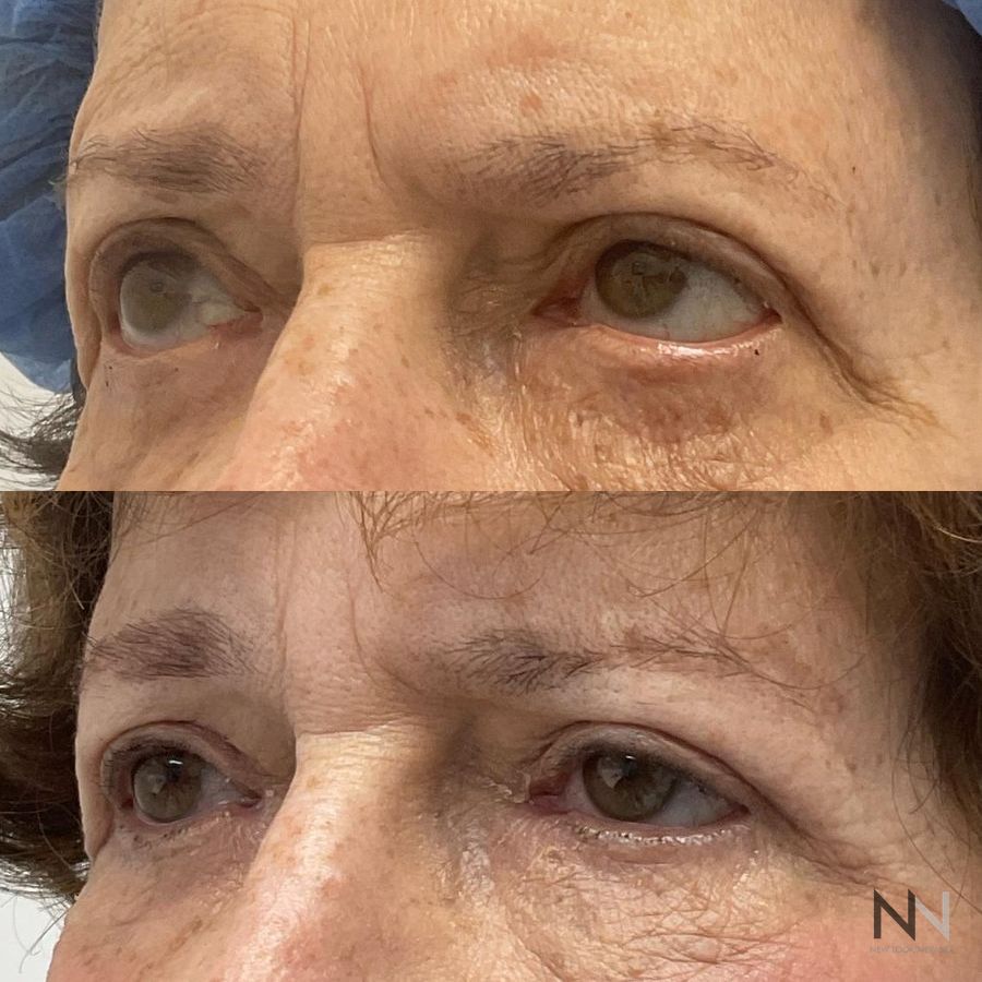 Blepharoplasty - Thumbnail 2