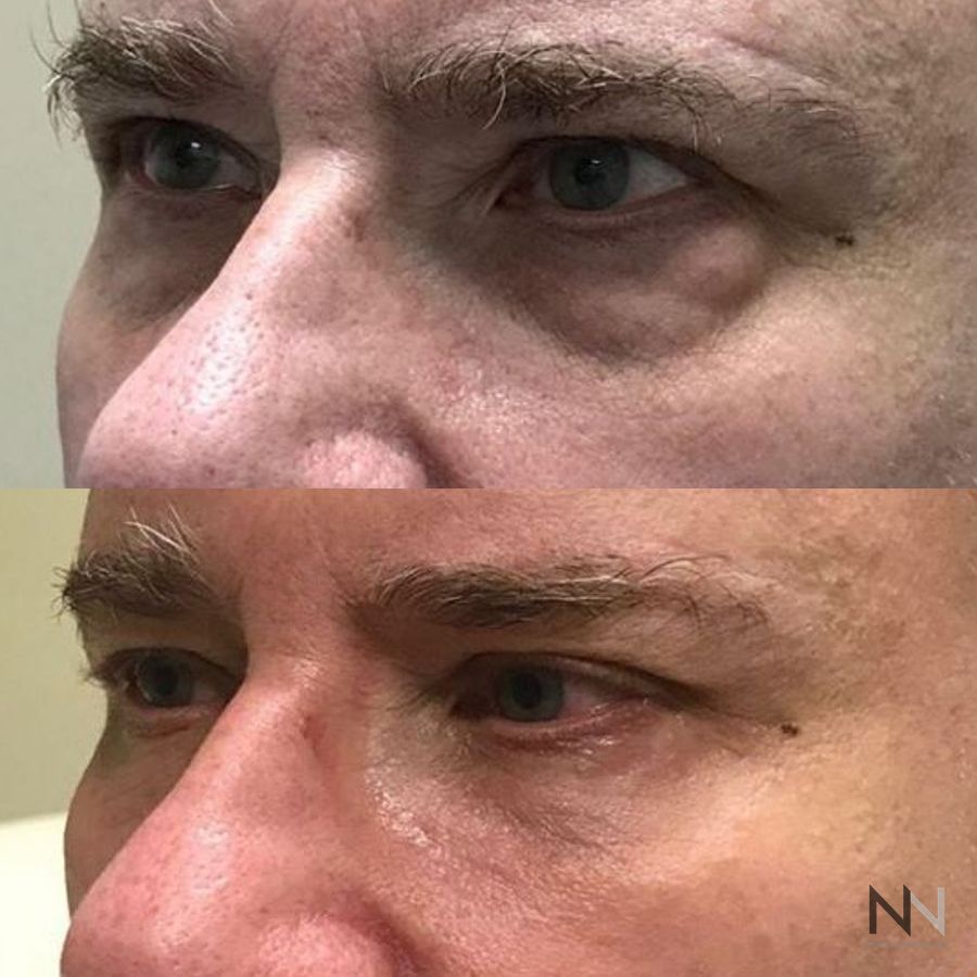 Blepharoplasty - Case 1943