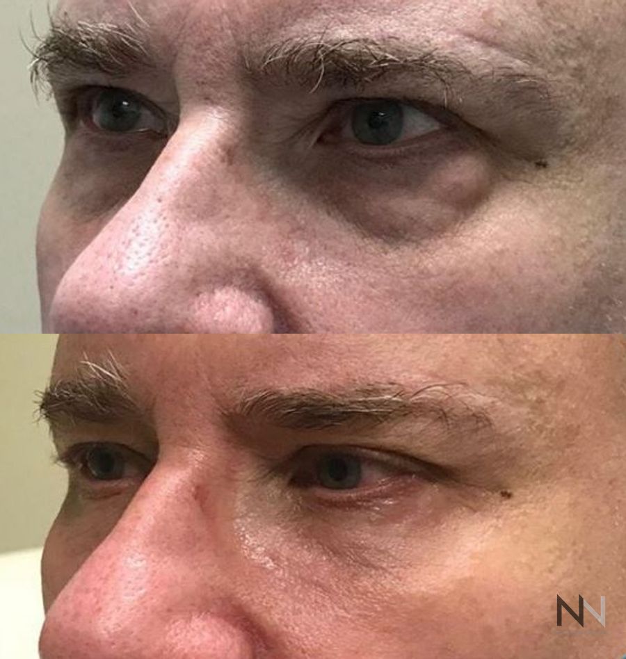 Under eye surgery showing reduced puffiness and smoother skin