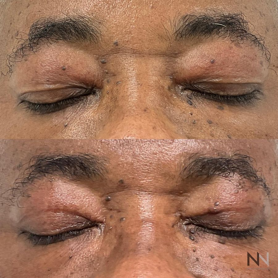 Blepharoplasty - Thumbnail 2