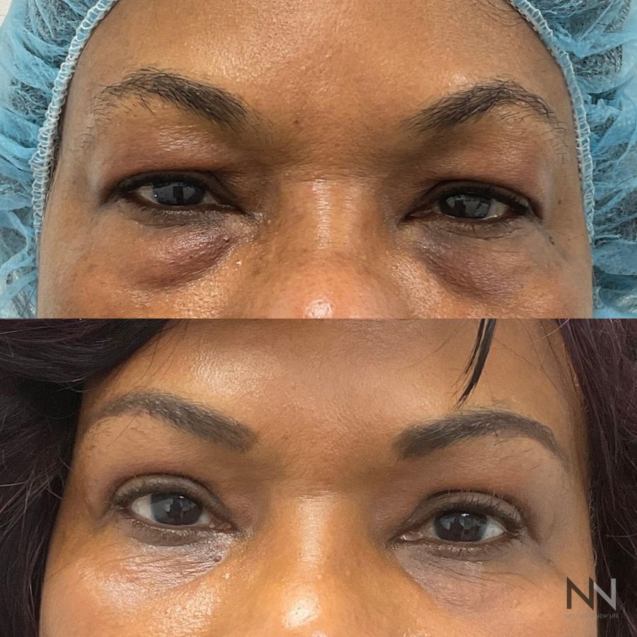 Blepharoplasty - Thumbnail 2