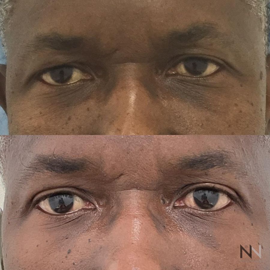Blepharoplasty - Case 1941