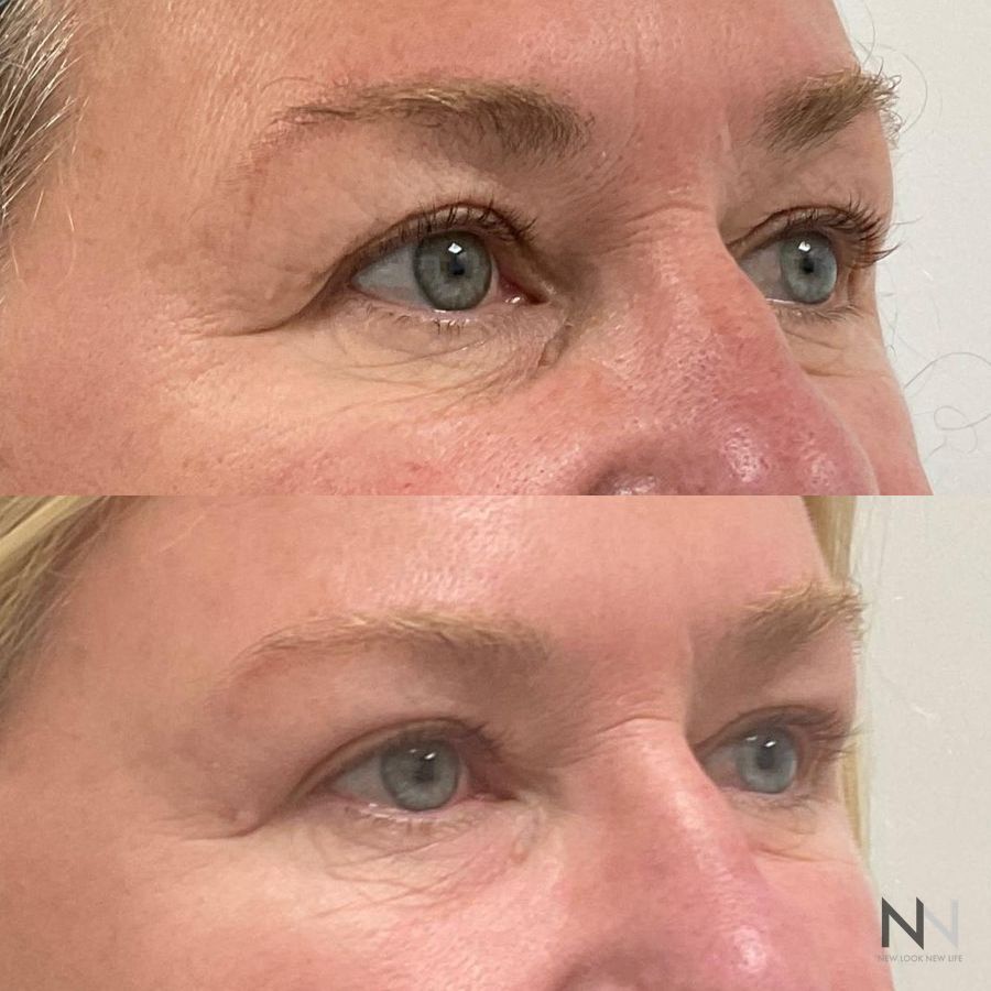 Blepharoplasty - Thumbnail 2