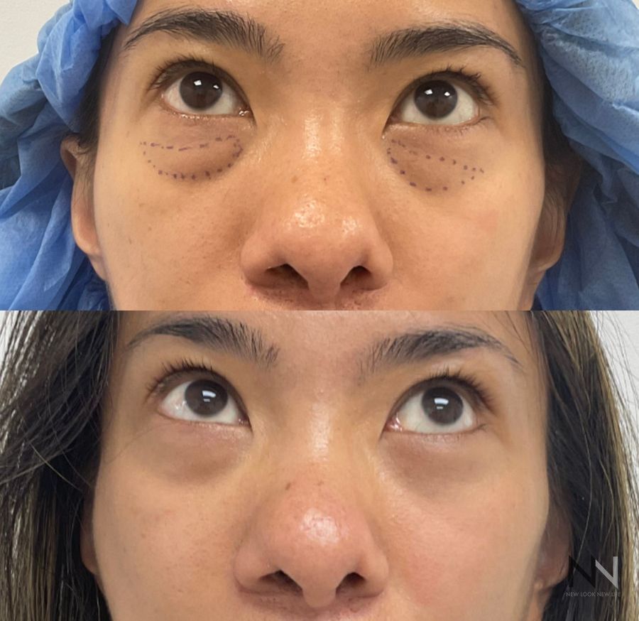 Lower blepharoplasty before and after showing refined lower eyelid contours and improved under-eye appearance by Dr. Claudia Kim in NYC. - Angle 3