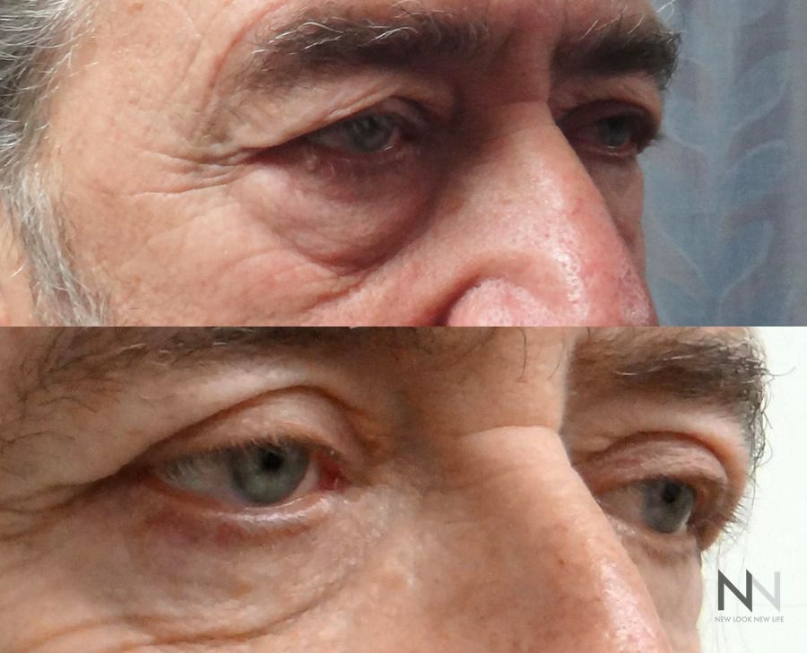 Before and after upper and lower blepharoplasty three months results - Angle 2