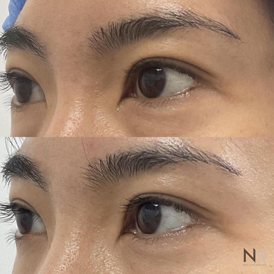 Blepharoplasty - Case 1946