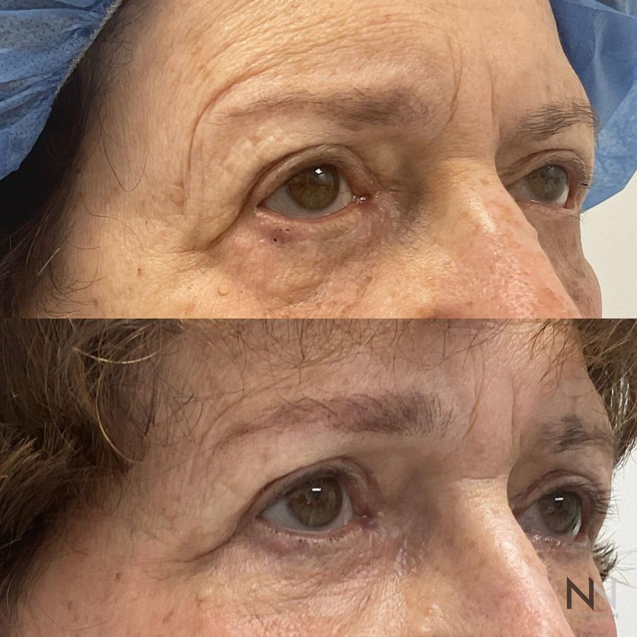 Blepharoplasty - Thumbnail 3