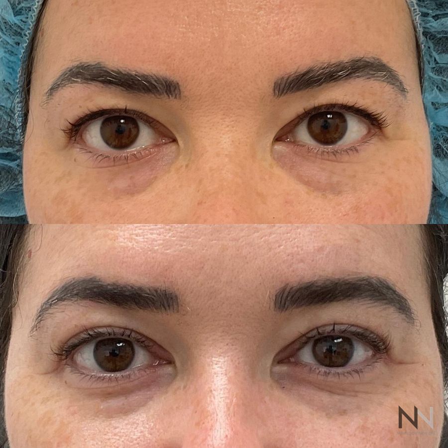 Blepharoplasty - Thumbnail 2