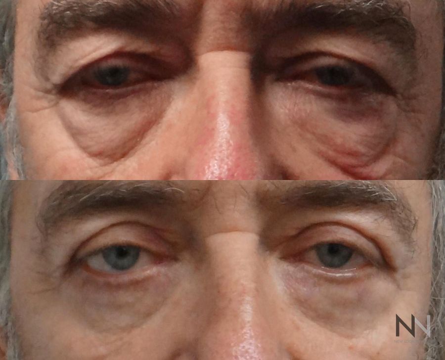 Before and after upper and lower blepharoplasty three months results - Angle 3