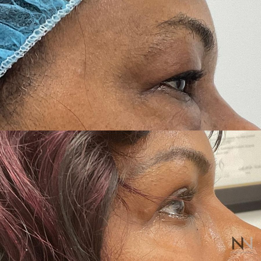 Blepharoplasty - Case 1950