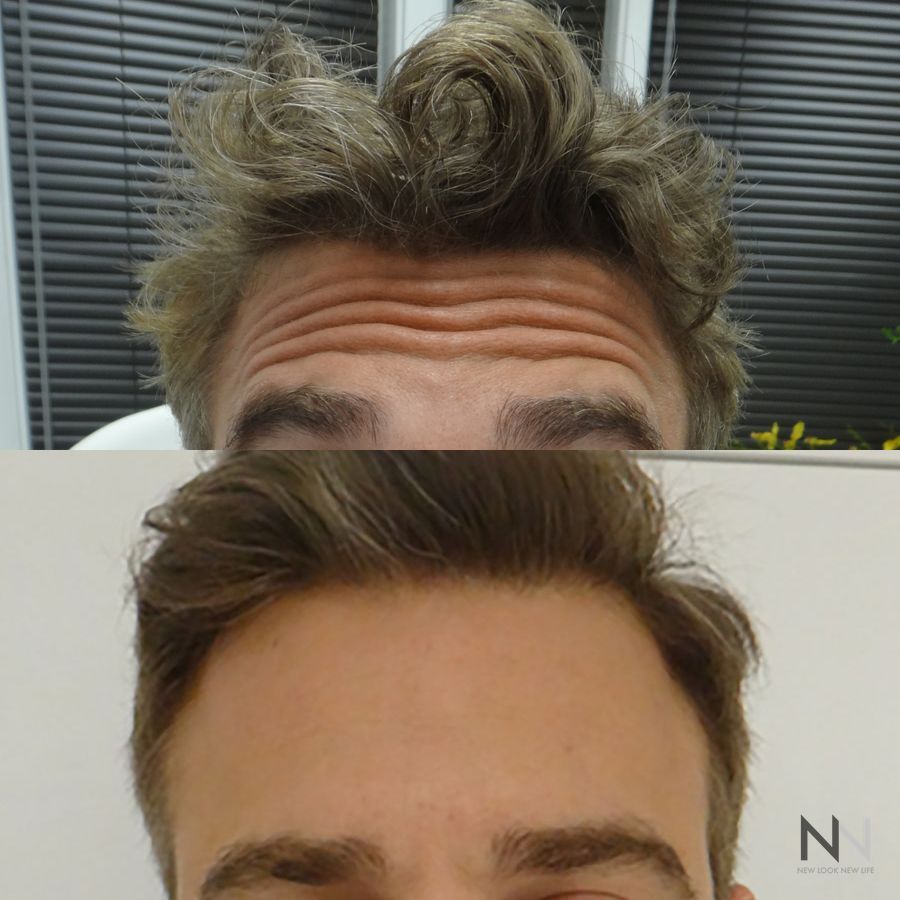 Botox and Dysport - Case 1665