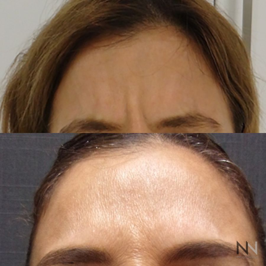 Botox and Dysport - Case 2193