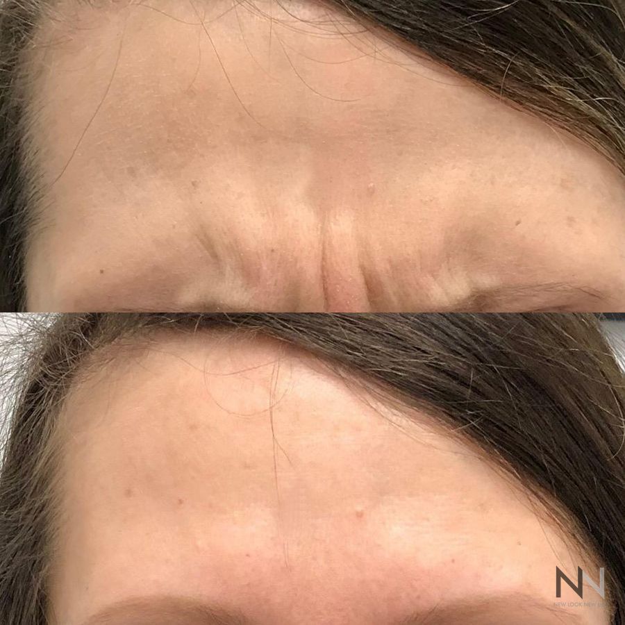 Botox and Dysport - Case 2191