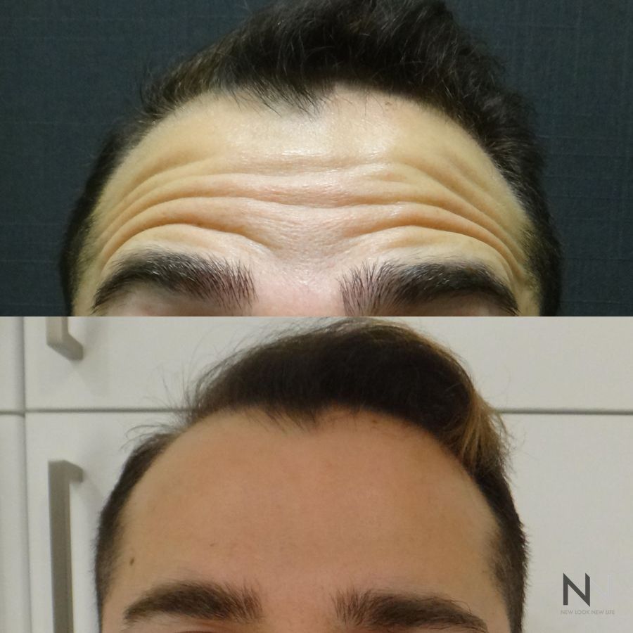 Botox and Dysport - Case 1667